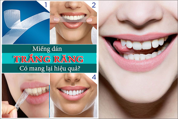 Sử dụng miếng dán trắng răng có mang lại hiệu quả?
