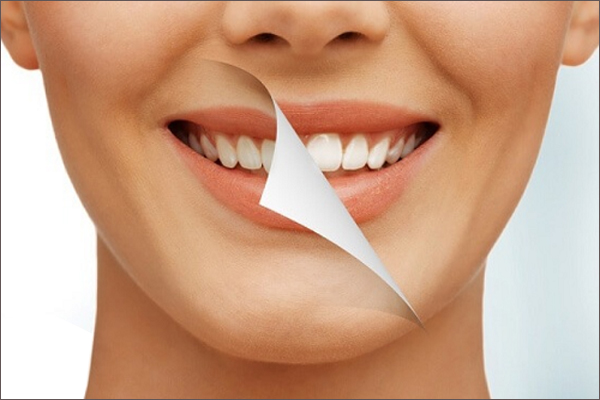 Thắc mắc tẩy trắng răng có hại không?